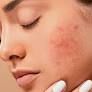 Dị ứng kem chống nắng